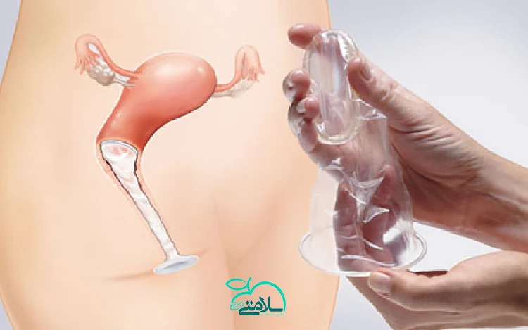 تمام آنچه که باید در خصوص کاندوم زنانه و نحوه استفاده ی آن بدانید